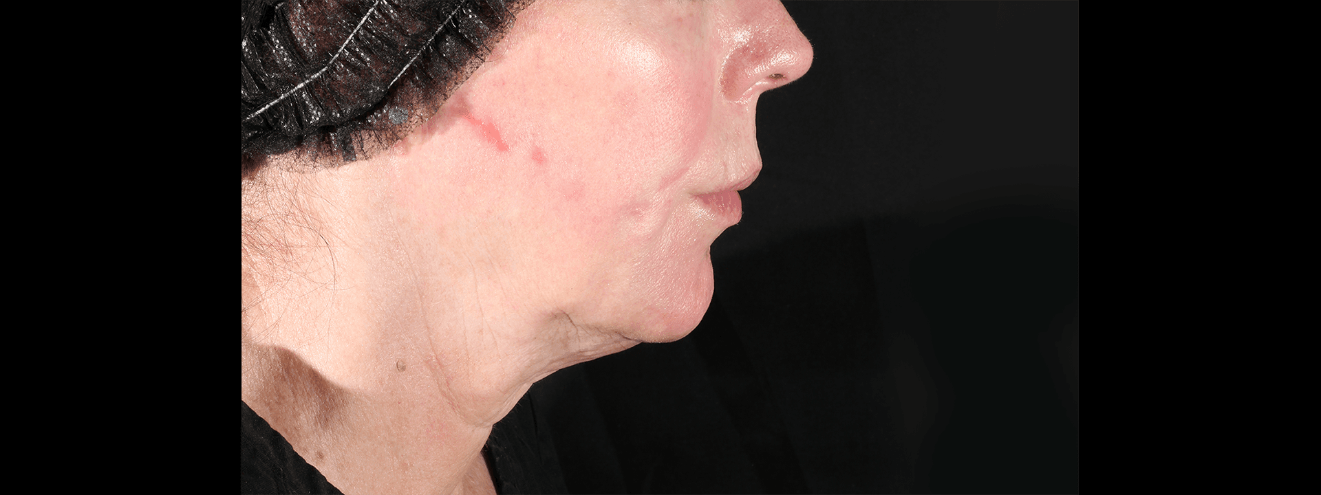 Before and after 2 treatments. before