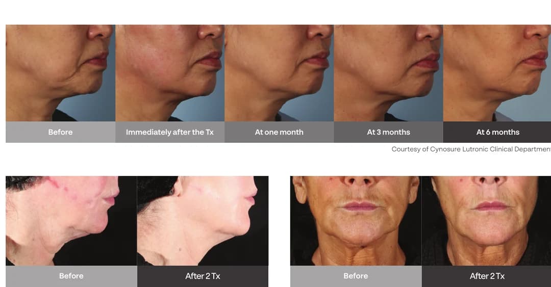 XERF collagen building timeline and before after provider documentation.
