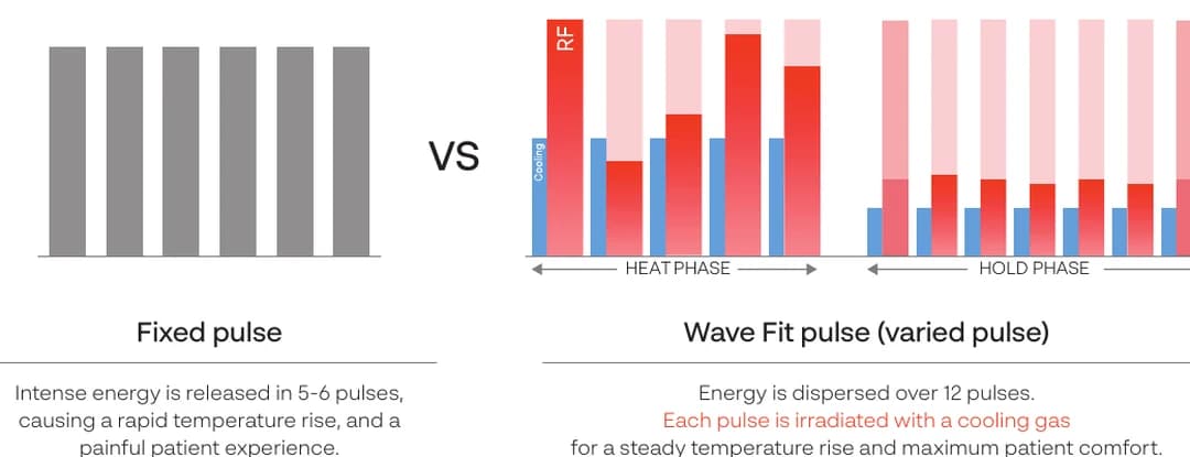 XERF Wave Fit pulse comparison showing fixed pulse versus varied pulse delivery.