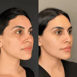 Facial contouring before and after treatment result.