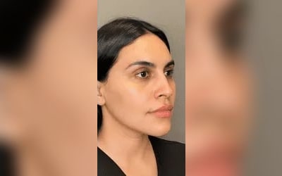 Skin Rejuvenation after