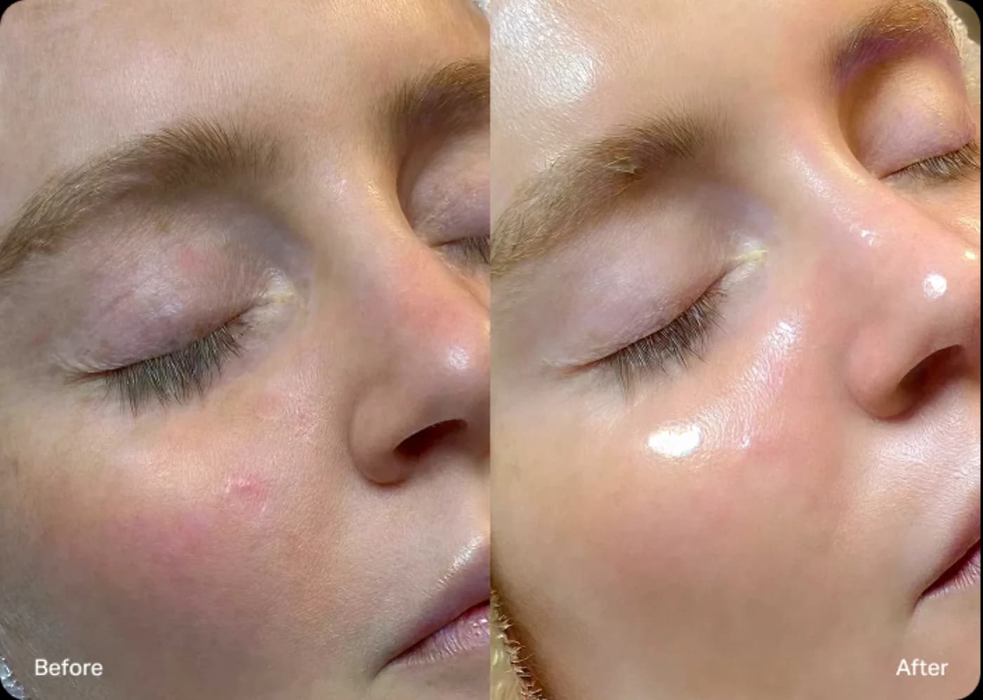 Hydrafacial before and after for dull and dehydrated skin.